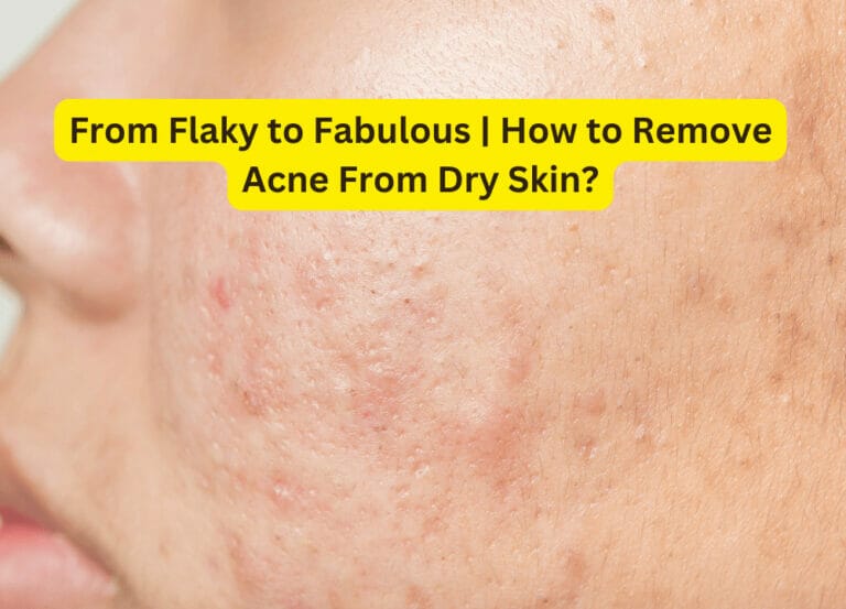 From Flaky to Fabulous | How to Remove Acne From Dry Skin?