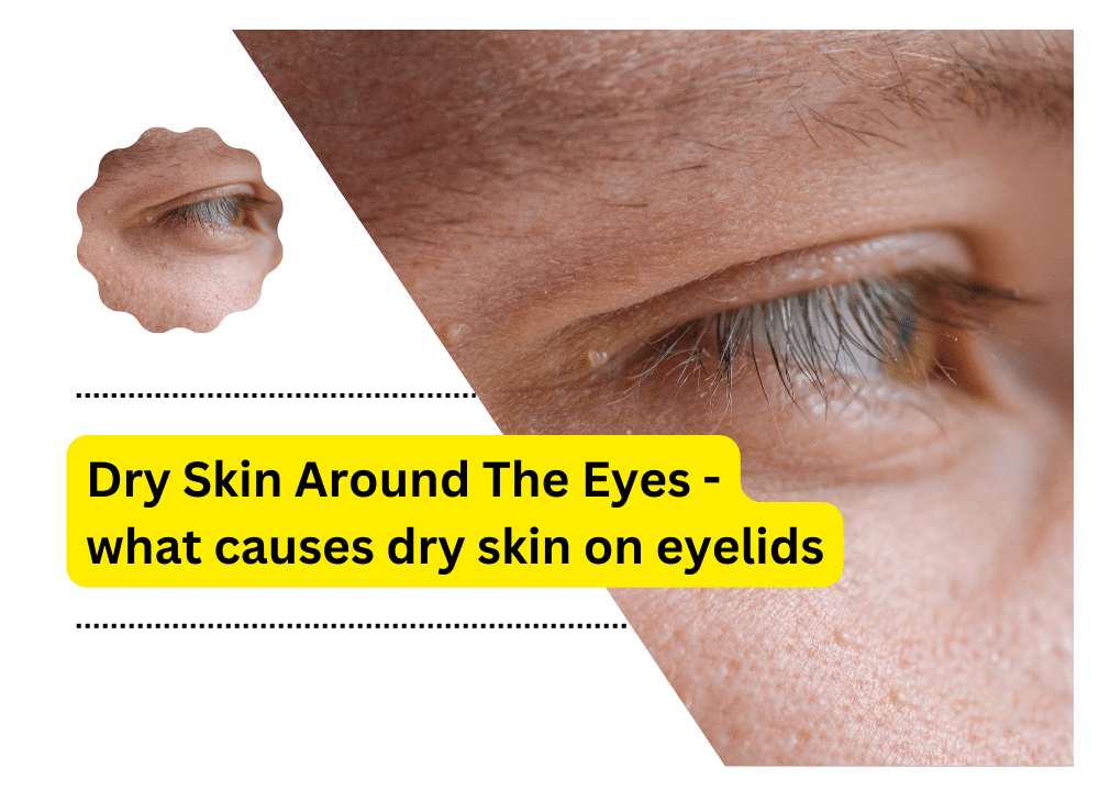 what causes dry skin on eyelids