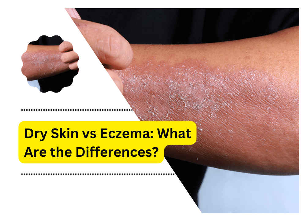 Dry Skin vs Eczema