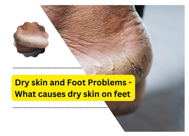 Dry skin and Foot Problems – What causes dry skin on feet