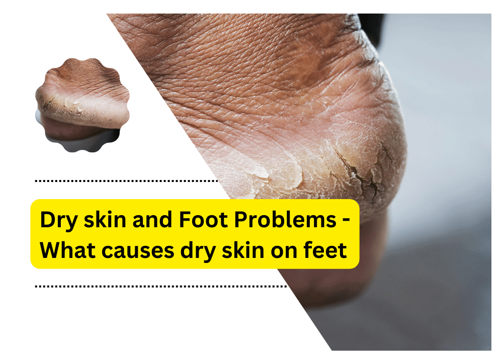 What causes dry skin on feet