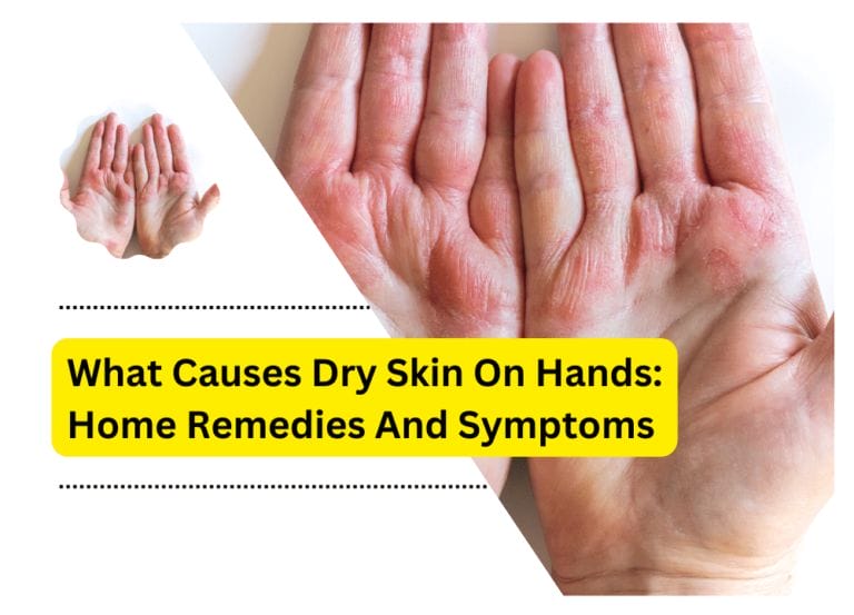 What Causes Dry Skin On Hands: Home Remedies And Symptoms