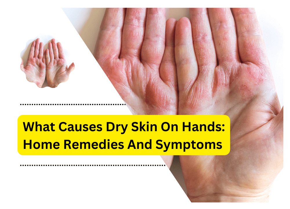 rough-severely-dry-skin-on-hand-causes-and-treatment-skincarederm