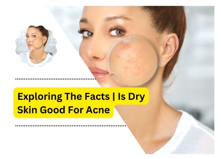Exploring The Facts | Is Dry Skin Good For Acne