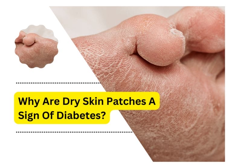 Why Are Dry Skin Patches A Sign Of Diabetes?