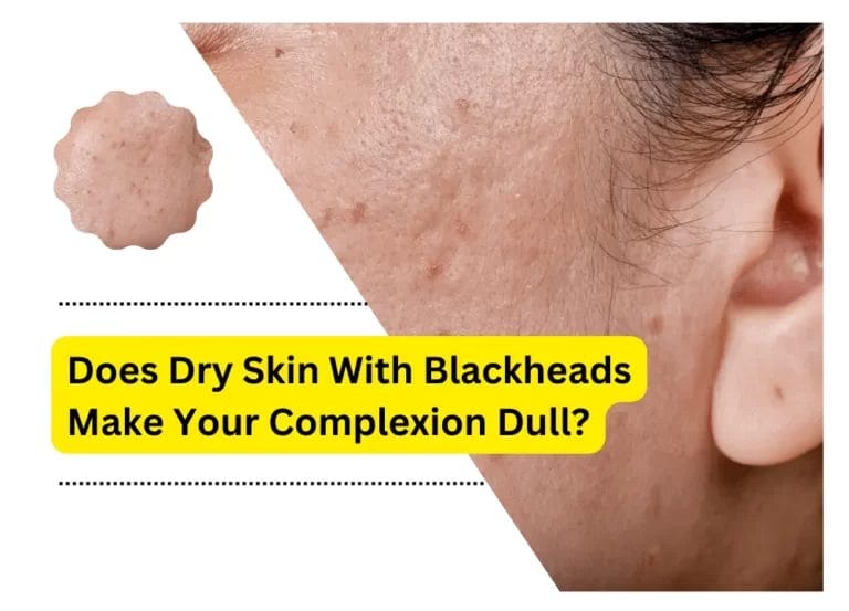 Does Dry Skin With Blackheads Make Your Complexion Dull?