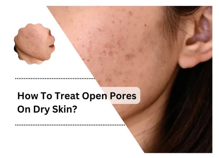 How To Treat Open Pores On Dry Skin?