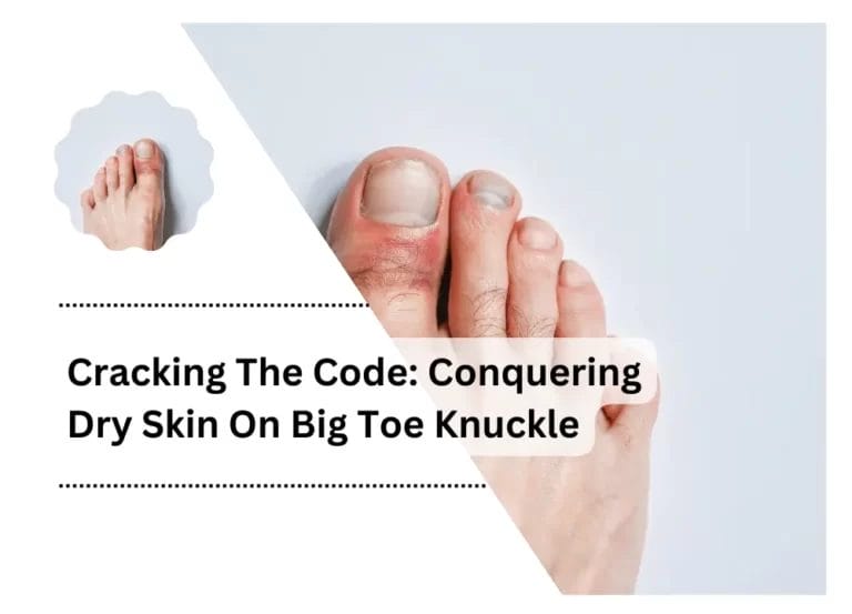 Cracking The Code: Conquering Dry Skin On Big Toe Knuckle