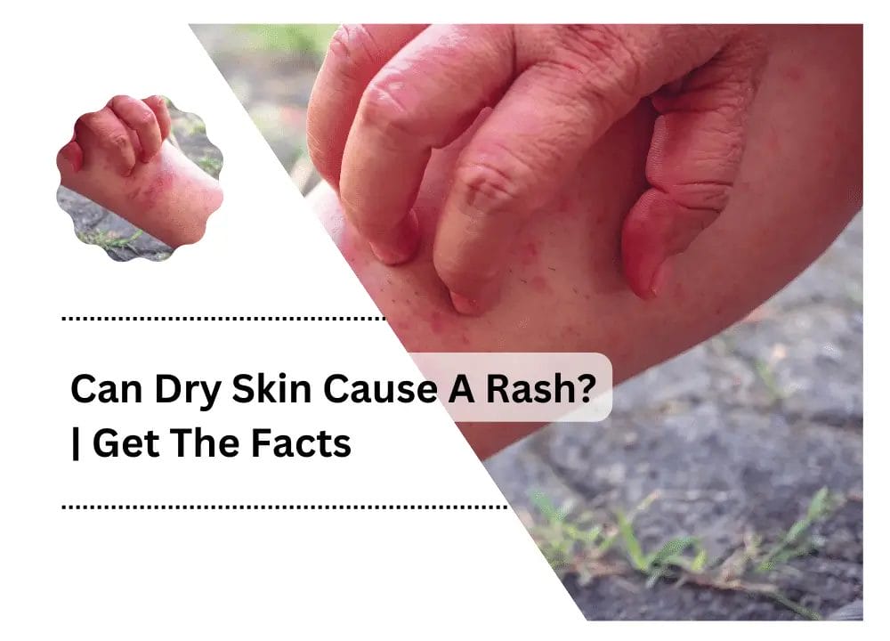 Can Dry Skin Cause A Rash