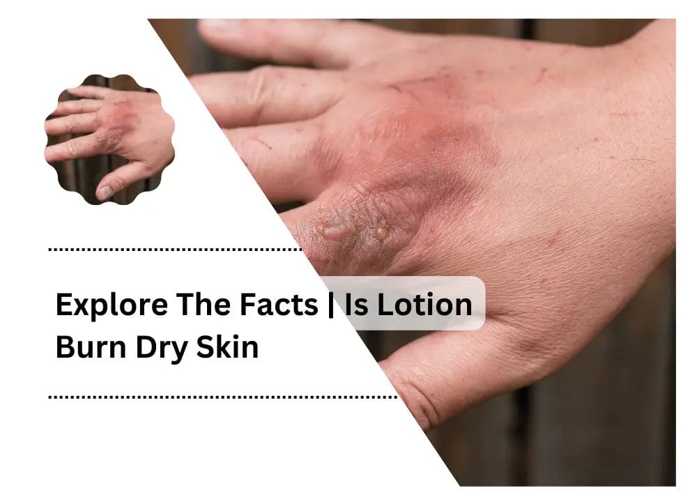 Lotion Burn Dry Skin