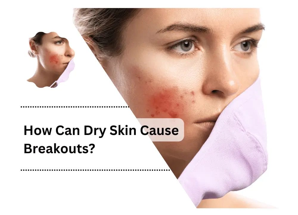 Can Dry Skin Cause Breakouts