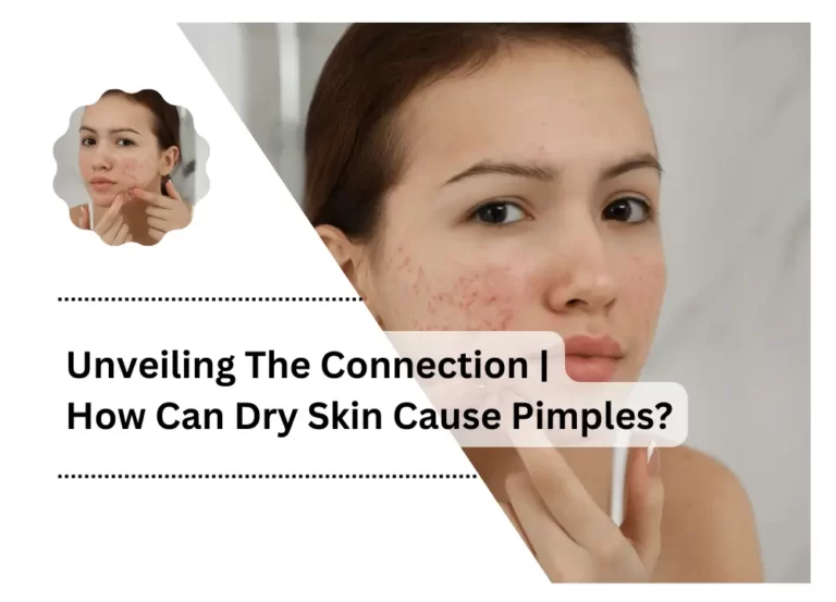 Unveiling The Connection | How Can Dry Skin Cause Pimples?