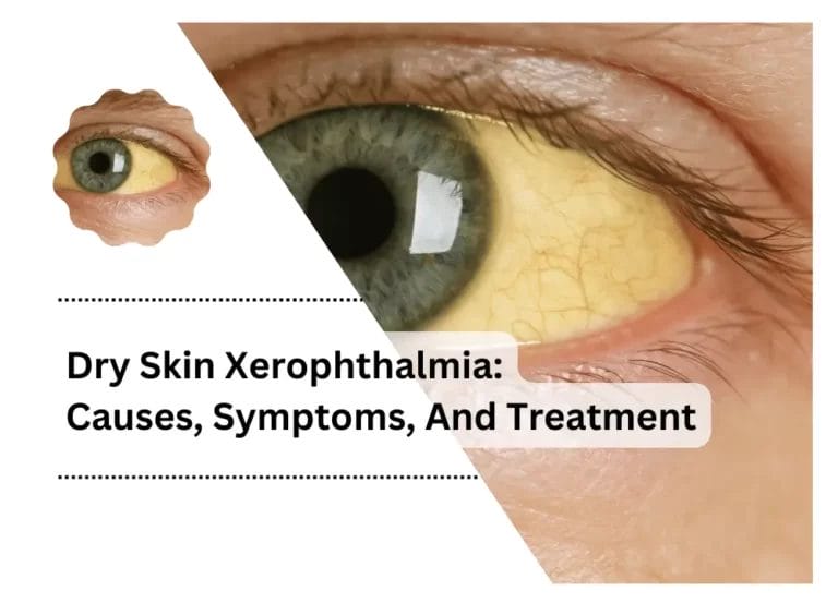 Dry Skin Xerophthalmia: Causes, Symptoms, And Treatment