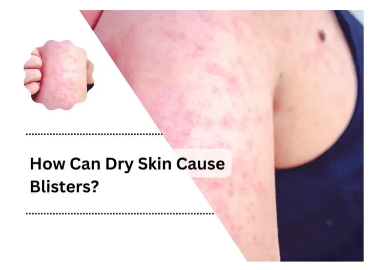 How Can Dry Skin Cause Blisters?