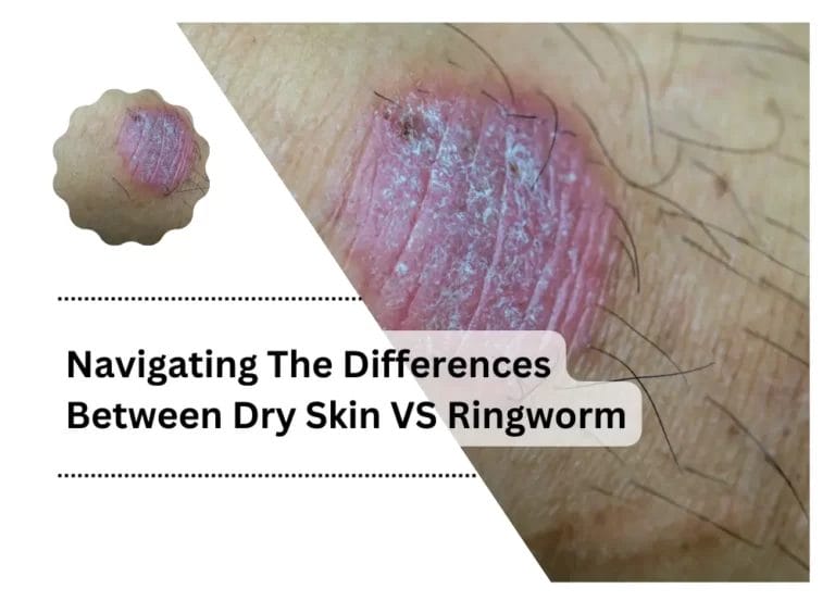 Navigating The Differences Between Dry Skin VS Ringworm