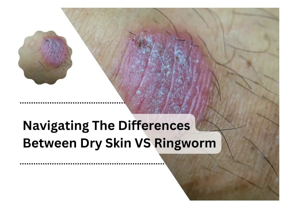 Dry Skin VS Ringworm