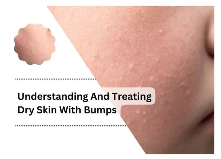 Understanding And Treating Dry Skin With Bumps
