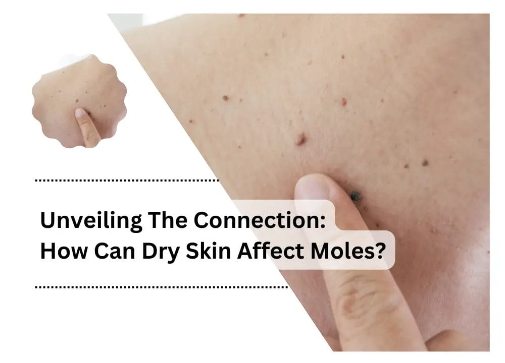 Can Dry Skin Affect Moles
