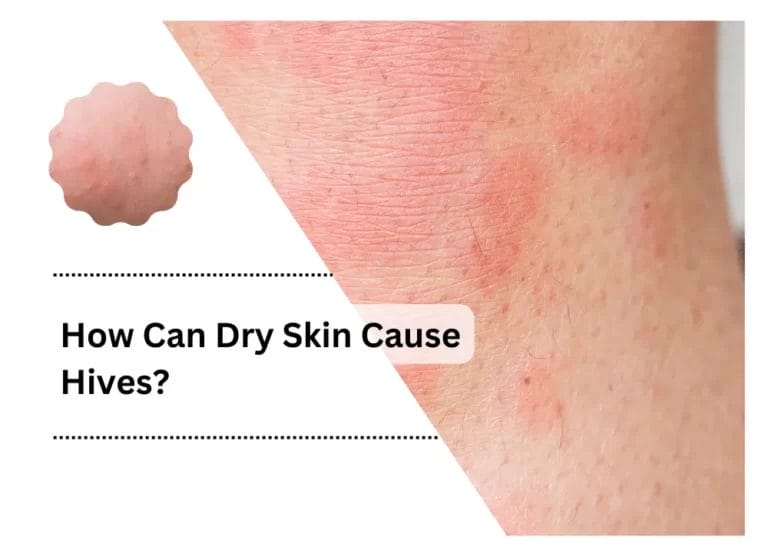 How Can Dry Skin Cause Hives?