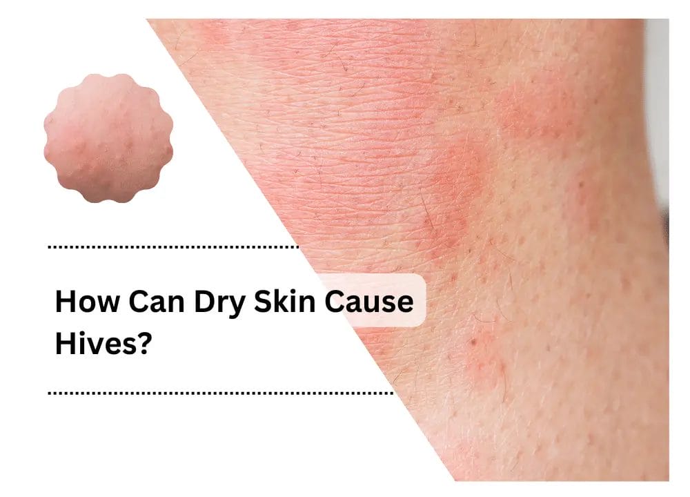 Can Dry Skin Cause Hives