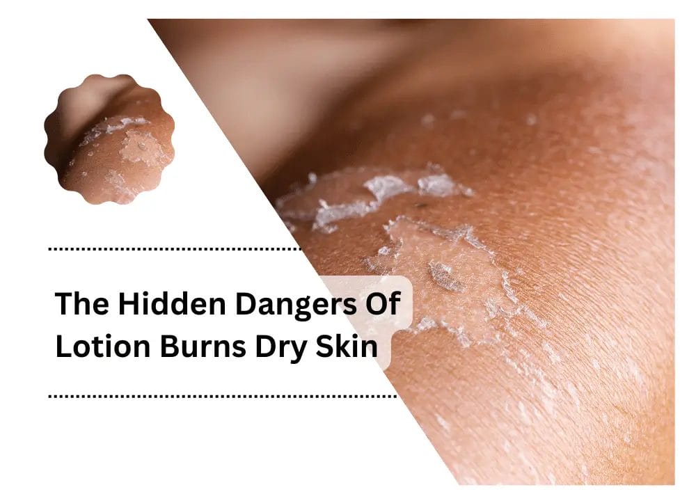 Lotion Burns Dry Skin