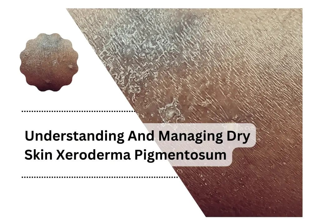 Dry Skin Xeroderma Pigmentosum