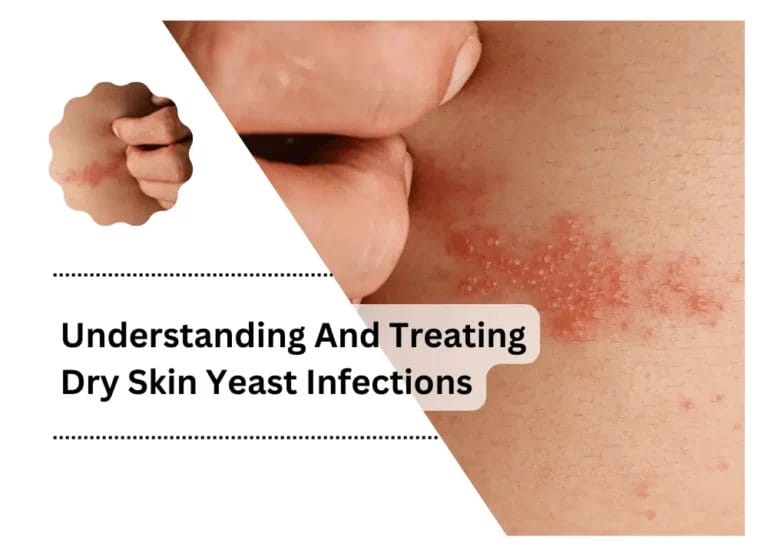 Understanding And Treating Dry Skin Yeast Infections