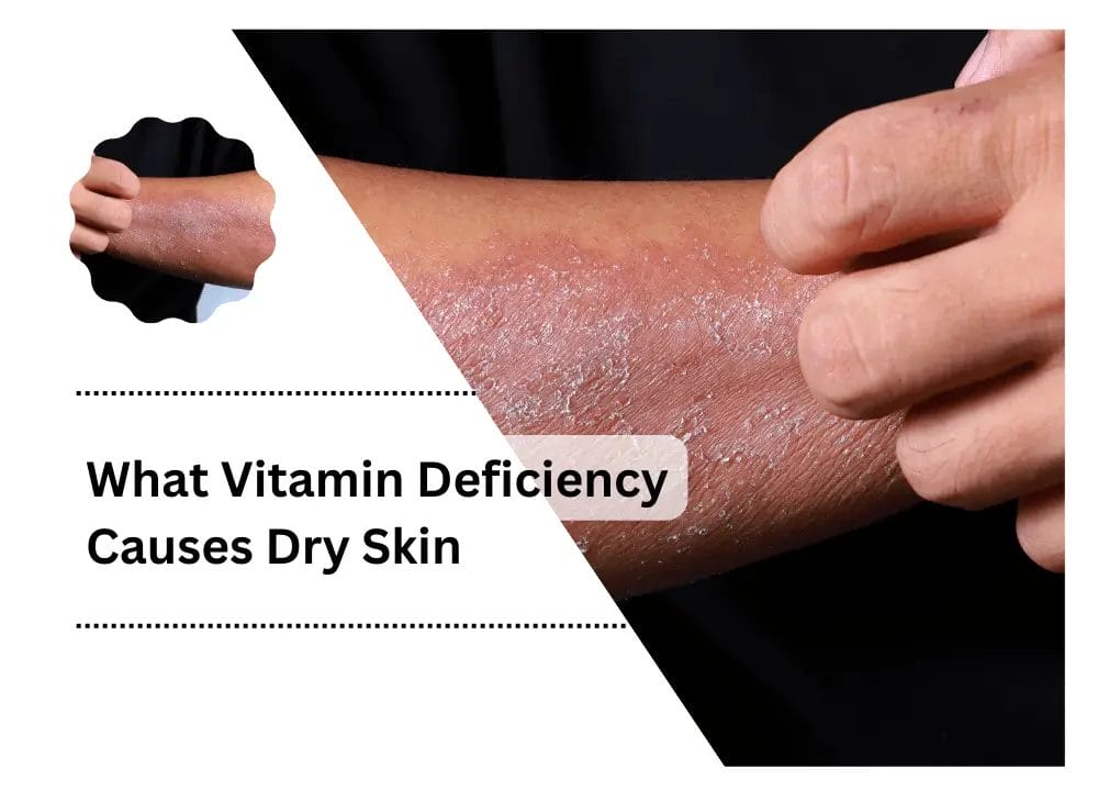 What Vitamin Deficiency Causes Dry Skin