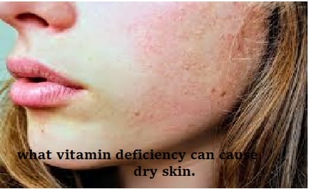 Dry Skin vitamins Deficiency